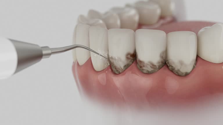 Trusted Wisdom Tooth Removal service in Joshua Tree, CA - Dentist Open Now